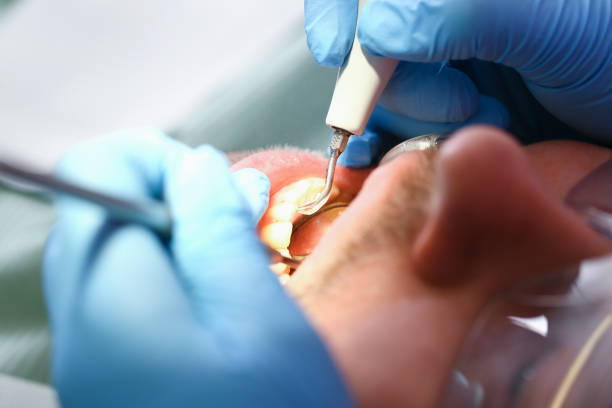 Best Dental Abscess Treatment in Van, TX