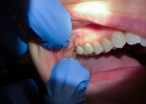 Best Broken or Chipped Tooth Repair in Van, TX